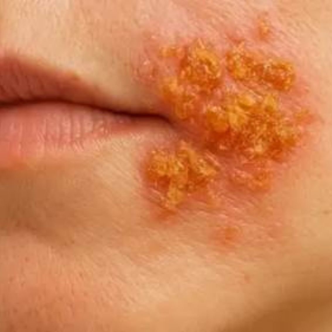 Dermatitis atópica