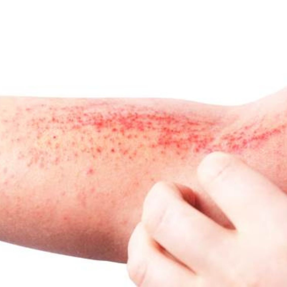 Dermatitis atópica