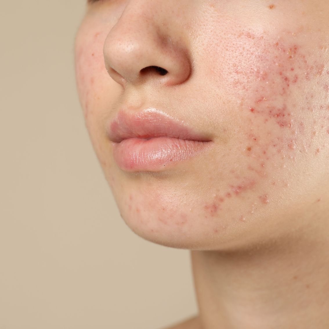 Tratamiento dermatológico para acné y rosácea